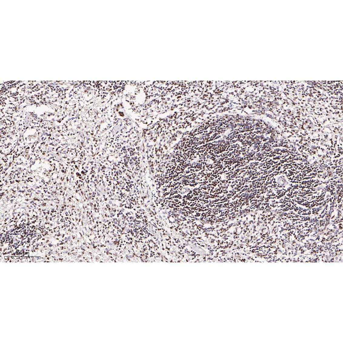 WR4014 Immunohistochemical analysis of paraffin-embedded rat spleen tissue. 1, primary Antibody was diluted at 1:200(4~C,overnight). 2, EDTA pH 9.0 was used for antibody retrieval(>98~C,20min). 3,Secondary antibody was diluted at 1:200(room tempeRature, 30min). Immunohistochemical analysis of paraffin-embedded rat spleen tissue. 1, primary Antibody was diluted at 1:200(4~C,overnight). 2, EDTA pH 9.0 was used for antibody retrieval(>98~C,20min). 3,Secondary antibody was diluted at 1:200(room tempeRature, 30min).