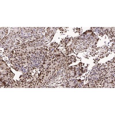 Immunohistochemical analysis of paraffin-embedded human bladder carcinoma tissue. 1, primary Antibody was diluted at 1:200(4～C,overnight). 2, EDTA pH 9.0 was used for antibody retrieval(>98～C,20min). 3,Secondary antibody was diluted at 1:200(room tempeRature, 30min).