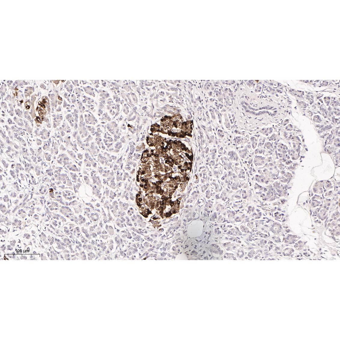 WR4034 Immunohistochemical analysis of paraffin-embedded Human pancreas tissue. 1, primary Antibody was diluted at 1:200(4~C,overnight). 2, EDTA pH 9.0 was used for antibody retrieval(>98~C,20min). 3,Secondary antibody was diluted at 1:200(room tempeRature, 30min). Immunohistochemical analysis of paraffin-embedded Human pancreas tissue. 1, primary Antibody was diluted at 1:200(4~C,overnight). 2, EDTA pH 9.0 was used for antibody retrieval(>98~C,20min). 3,Secondary antibody was diluted at 1:200(room tempeRature, 30min).