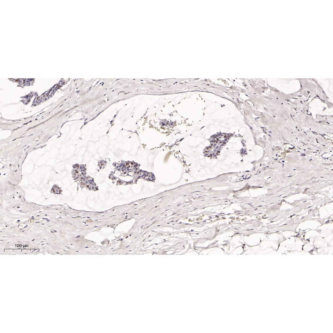WR4055 Immunohistochemical analysis of paraffin-embedded human breast carcinoma tissue. 1, primary Antibody was diluted at 1:200(4~C,overnight). 2, EDTA pH 9.0 was used for antibody retrieval(>98~C,20min). 3,Secondary antibody was diluted at 1:200(room tempeRature, 30min). Immunohistochemical analysis of paraffin-embedded human breast carcinoma tissue. 1, primary Antibody was diluted at 1:200(4~C,overnight). 2, EDTA pH 9.0 was used for antibody retrieval(>98~C,20min). 3,Secondary antibody was diluted at 1:200(room tempeRature, 30min).