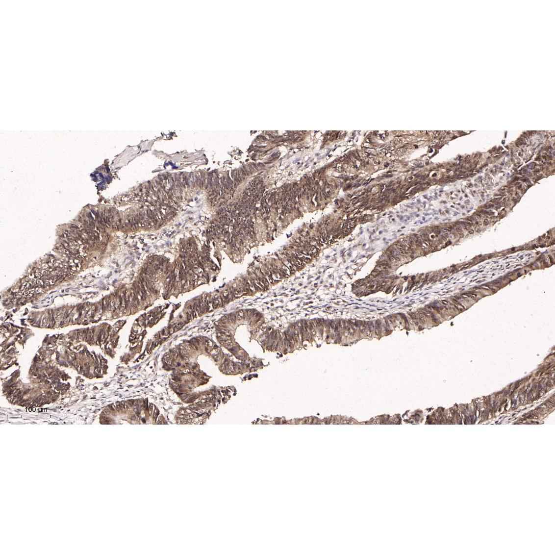 WR4078 Immunohistochemical analysis of paraffin-embedded human colon tissue. 1, primary Antibody was diluted at 1:200(4~C,overnight). 2, EDTA pH 9.0 was used for antibody retrieval(>98~C,20min). 3,Secondary antibody was diluted at 1:200(room tempeRature, 30min). Immunohistochemical analysis of paraffin-embedded human colon tissue. 1, primary Antibody was diluted at 1:200(4~C,overnight). 2, EDTA pH 9.0 was used for antibody retrieval(>98~C,20min). 3,Secondary antibody was diluted at 1:200(room tempeRature, 30min).