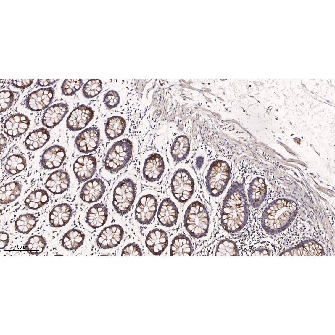 WR4084 Immunohistochemical analysis of paraffin-embedded human colon tissue. 1, primary Antibody was diluted at 1:200(4~C,overnight). 2, EDTA pH 9.0 was used for antibody retrieval(>98~C,20min). 3,Secondary antibody was diluted at 1:200(room tempeRature, 30min). Immunohistochemical analysis of paraffin-embedded human colon tissue. 1, primary Antibody was diluted at 1:200(4~C,overnight). 2, EDTA pH 9.0 was used for antibody retrieval(>98~C,20min). 3,Secondary antibody was diluted at 1:200(room tempeRature, 30min).