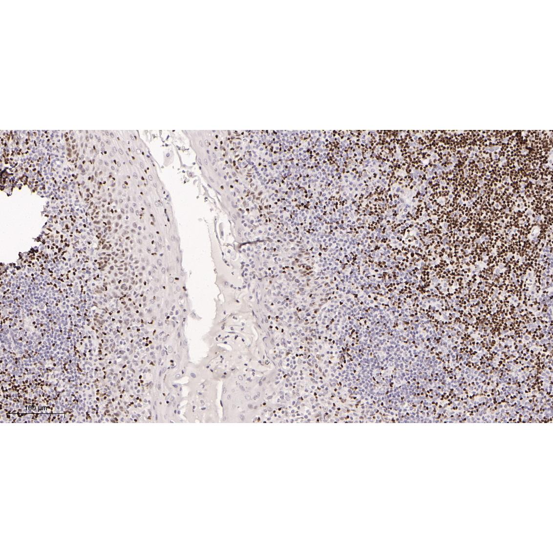 WR4110 Immunohistochemical analysis of paraffin-embedded human tonsil tissue. 1, primary Antibody was diluted at 1:200(4~C,overnight). 2, EDTA pH 9.0 was used for antibody retrieval(>98~C,20min). 3,Secondary antibody was diluted at 1:200(room tempeRature, 30min). Immunohistochemical analysis of paraffin-embedded human tonsil tissue. 1, primary Antibody was diluted at 1:200(4~C,overnight). 2, EDTA pH 9.0 was used for antibody retrieval(>98~C,20min). 3,Secondary antibody was diluted at 1:200(room tempeRature, 30min).
