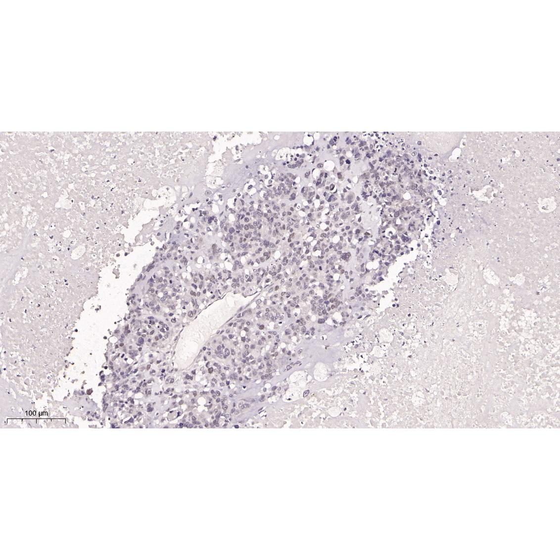 WR4122 Immunohistochemical analysis of paraffin-embedded human lung tissue. 1, primary Antibody was diluted at 1:200(4~C,overnight). 2, EDTA pH 9.0 was used for antibody retrieval(>98~C,20min). 3,Secondary antibody was diluted at 1:200(room tempeRature, 30min). Immunohistochemical analysis of paraffin-embedded human lung tissue. 1, primary Antibody was diluted at 1:200(4~C,overnight). 2, EDTA pH 9.0 was used for antibody retrieval(>98~C,20min). 3,Secondary antibody was diluted at 1:200(room tempeRature, 30min).