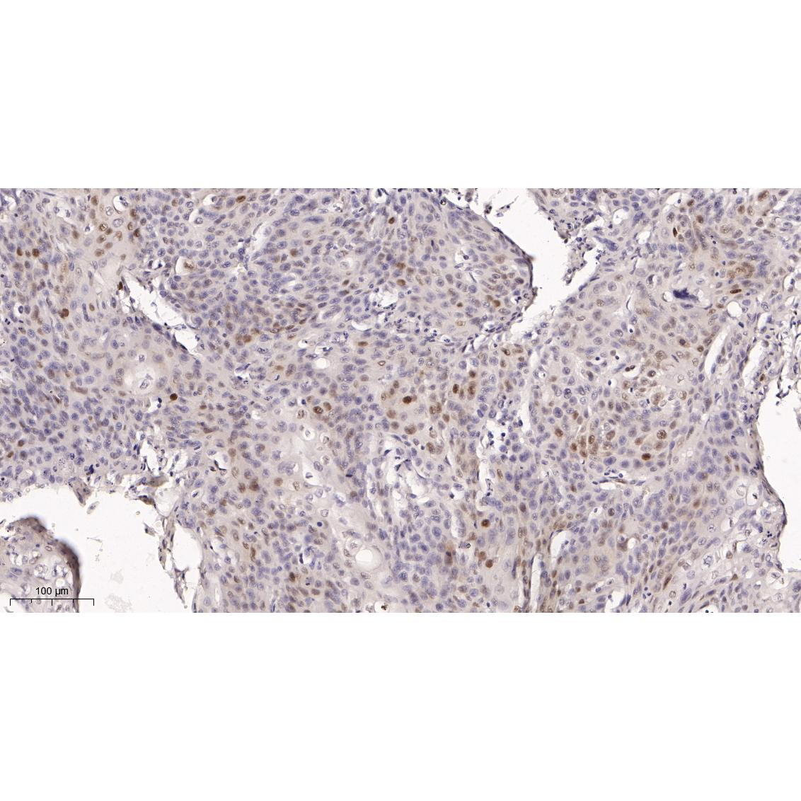 WR4127 Immunohistochemical analysis of paraffin-embedded Human cervical carcinoma tissue. 1, primary Antibody was diluted at 1:200(4~C,overnight). 2, EDTA pH 9.0 was used for antibody retrieval(>98~C,20min). 3,Secondary antibody was diluted at 1:200(room tempeRature, 30min). Immunohistochemical analysis of paraffin-embedded Human cervical carcinoma tissue. 1, primary Antibody was diluted at 1:200(4~C,overnight). 2, EDTA pH 9.0 was used for antibody retrieval(>98~C,20min). 3,Secondary antibody was diluted at 1:200(room tempeRature, 30min).