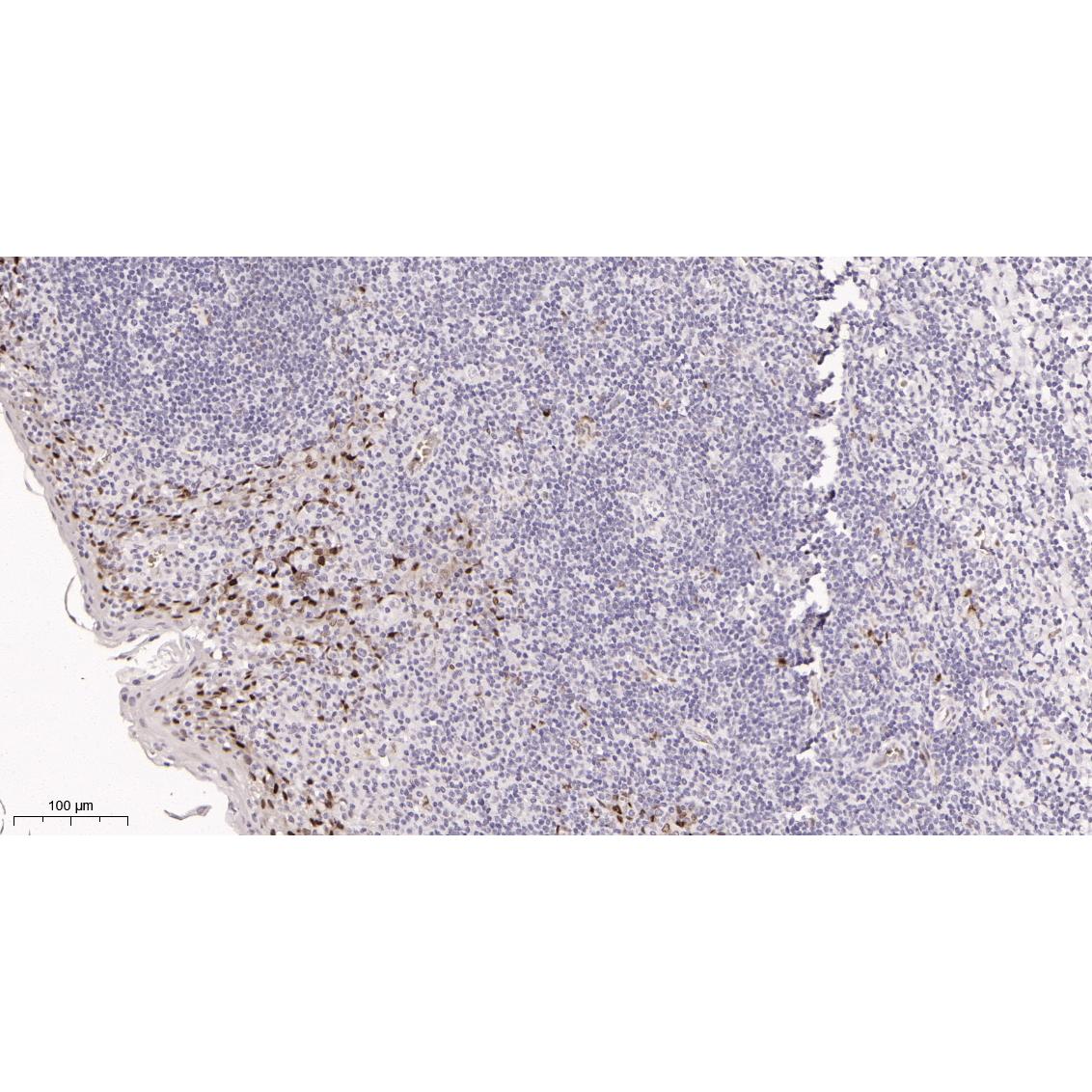 WR4128 Immunohistochemical analysis of paraffin-embedded human tonsil tissue. 1, primary Antibody was diluted at 1:200(4~C,overnight). 2, EDTA pH 9.0 was used for antibody retrieval(>98~C,20min). 3,Secondary antibody was diluted at 1:200(room tempeRature, 30min). Immunohistochemical analysis of paraffin-embedded human tonsil tissue. 1, primary Antibody was diluted at 1:200(4~C,overnight). 2, EDTA pH 9.0 was used for antibody retrieval(>98~C,20min). 3,Secondary antibody was diluted at 1:200(room tempeRature, 30min).