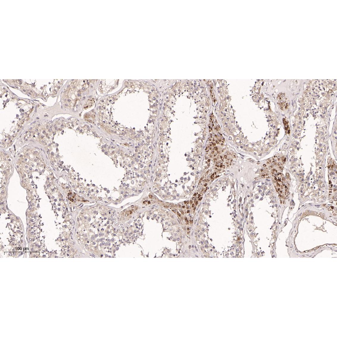 WR4158 Immunohistochemical analysis of paraffin-embedded Human testis tissue. 1, primary Antibody was diluted at 1:200(4~C,overnight). 2, EDTA pH 9.0 was used for antibody retrieval(>98~C,20min). 3,Secondary antibody was diluted at 1:200(room tempeRature, 30min). Immunohistochemical analysis of paraffin-embedded Human testis tissue. 1, primary Antibody was diluted at 1:200(4~C,overnight). 2, EDTA pH 9.0 was used for antibody retrieval(>98~C,20min). 3,Secondary antibody was diluted at 1:200(room tempeRature, 30min).