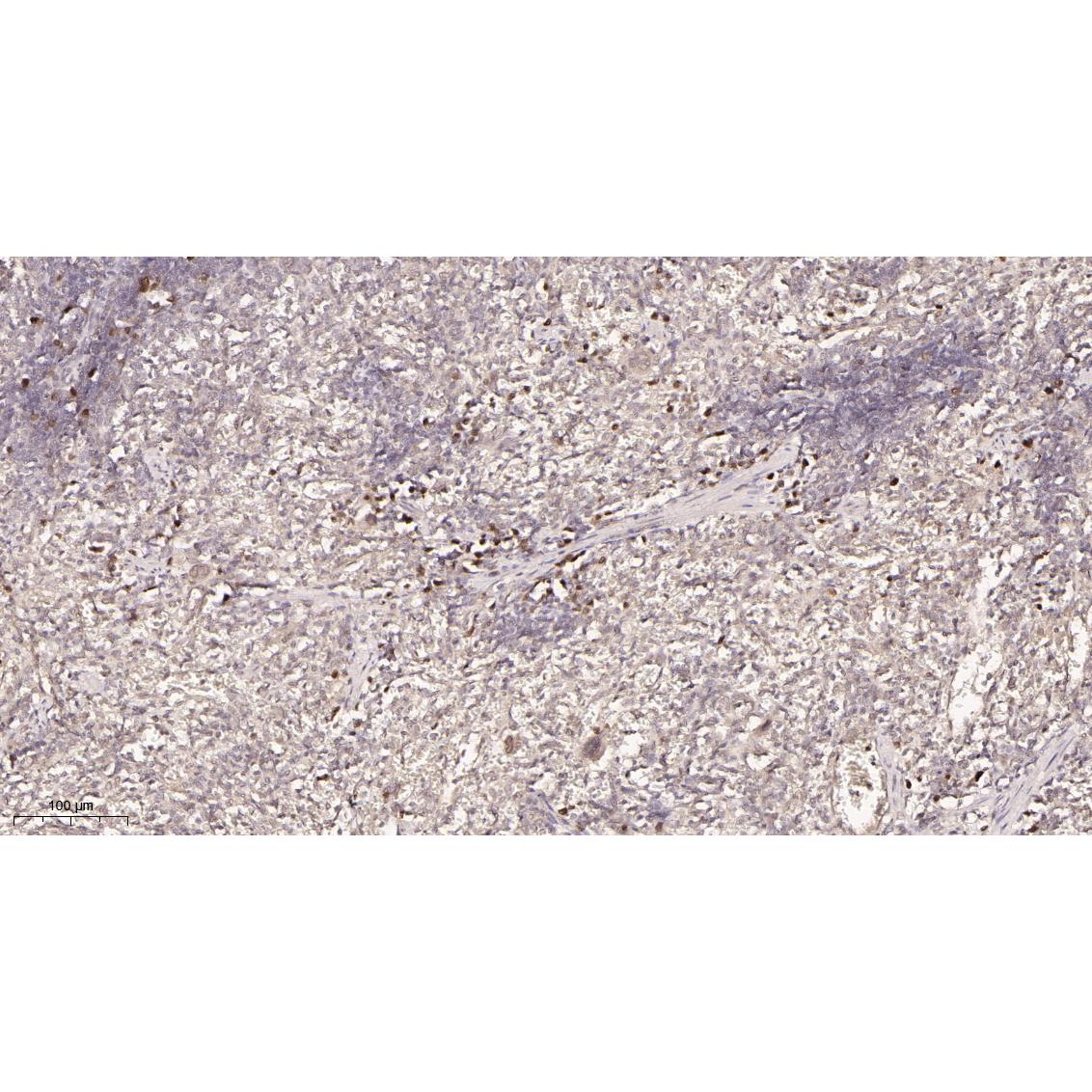 WR4167 Immunohistochemical analysis of paraffin-embedded Rat spleen tissue. 1, primary Antibody was diluted at 1:200(4~C,overnight). 2, EDTA pH 9.0 was used for antibody retrieval(>98~C,20min). 3,Secondary antibody was diluted at 1:200(room tempeRature, 30min). Immunohistochemical analysis of paraffin-embedded Rat spleen tissue. 1, primary Antibody was diluted at 1:200(4~C,overnight). 2, EDTA pH 9.0 was used for antibody retrieval(>98~C,20min). 3,Secondary antibody was diluted at 1:200(room tempeRature, 30min).
